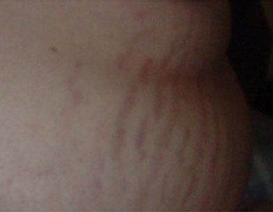 Stretch Marks