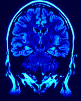 MRI of Brain